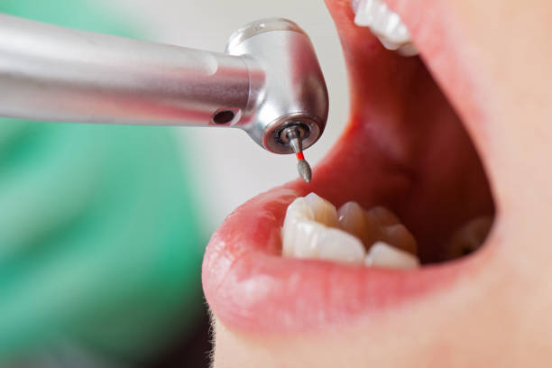 Best Emergency Root Canal Treatment in Rolling Meadows, IL